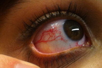 Ataxia-telangiectasia