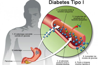 Diabetes Tipo 1