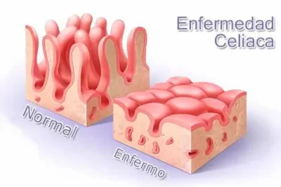 Enfermedad Celiaca