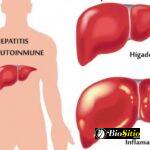 Hepatitis Autoinmune
