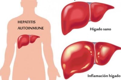 Hepatitis Autoinmune