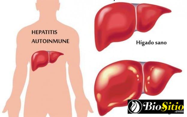 Hepatitis Autoinmune