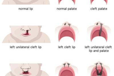 Síndrome De DiGeorge