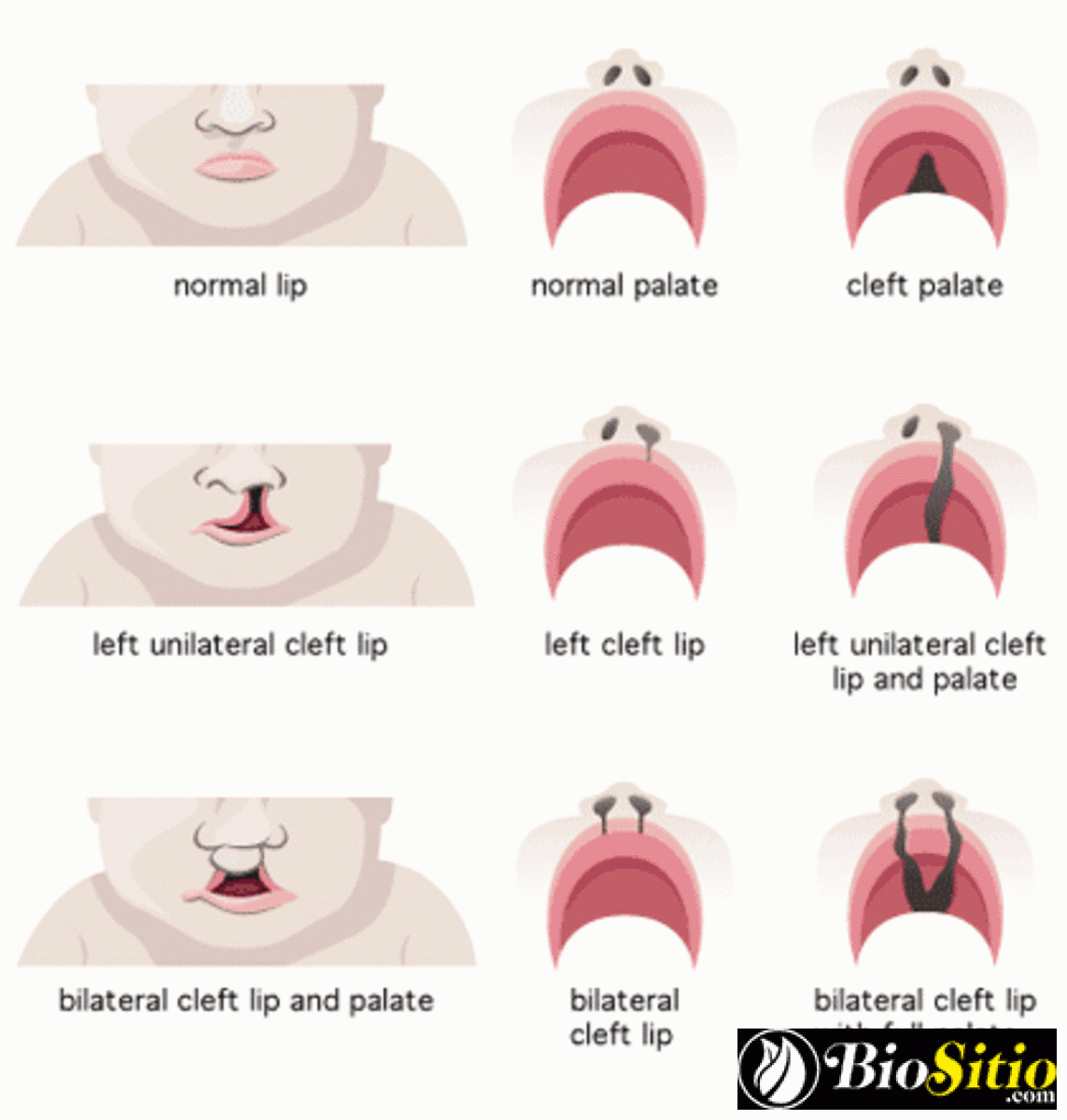 Síndrome De DiGeorge