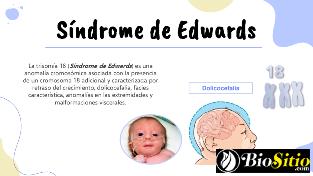 Síndrome De Edwards