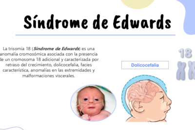 Síndrome De Edwards