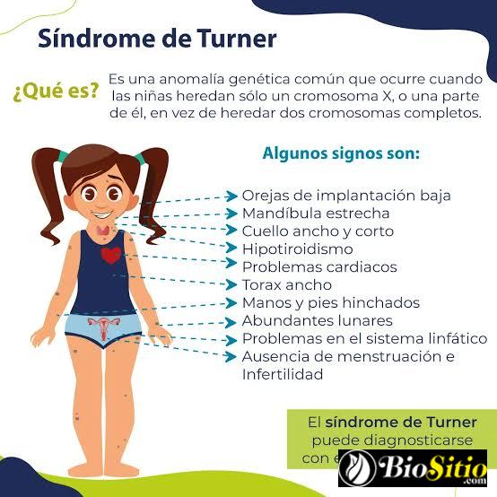 Síndrome De Turner: Efectos De Una Anomalía Cromosómica Femenina En El Desarrollo Físico Y Psicológico