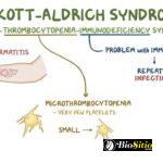 Síndrome De Wiscott-Aldrich