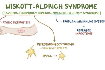 Síndrome De Wiscott-Aldrich