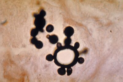 Paracoccidioides Brasiliensis