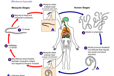 Wuchereria Bancrofti